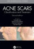 Acne Scars -- Bok 9781351717670